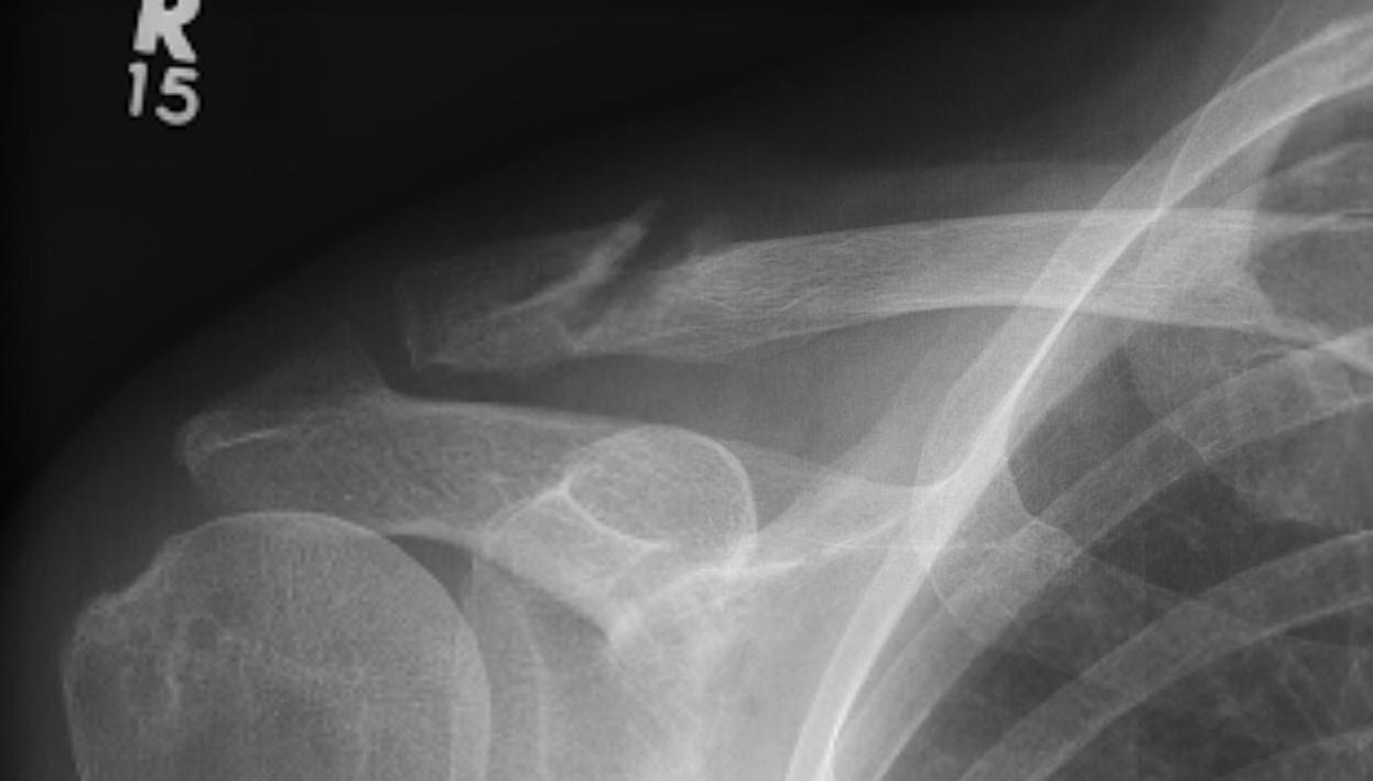 Lateral Clavicle Non union